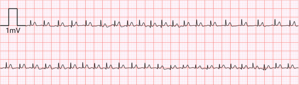Esempio di tracciato ECG